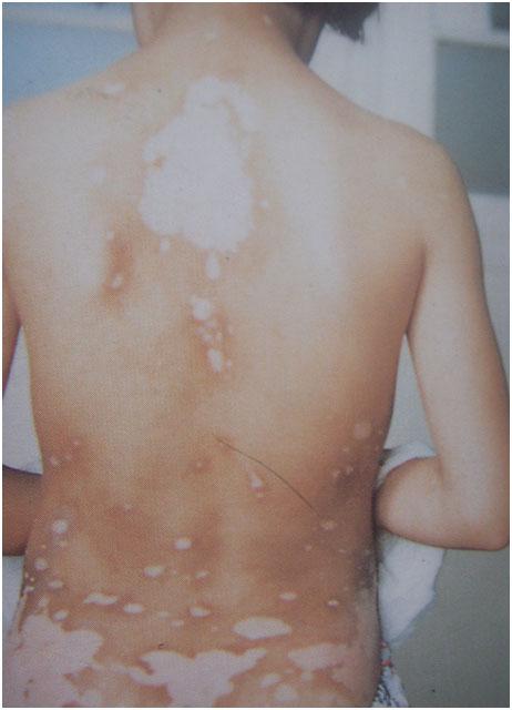 怎样护理节段型白癜风?