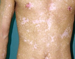 泛发型白癜风要做好哪些预防呢?