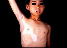 节段型白癜风好治吗?