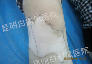 生活如此精彩 岂能因白癜风而毁坏