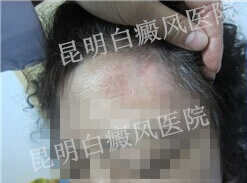 7年康复梦,祛白辛酸史