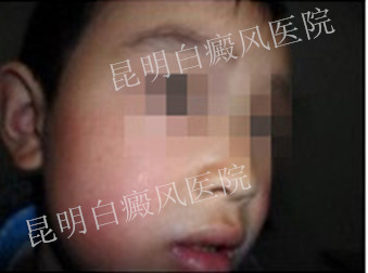 儿童/局限型/唇部左侧白斑