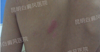 坚定乐观勇敢,战胜白斑病魔