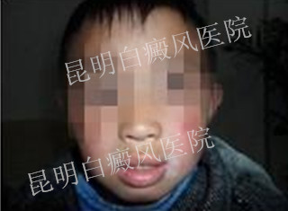 儿童/局限型/唇部左侧白斑