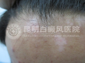 19岁男子面部白斑两年