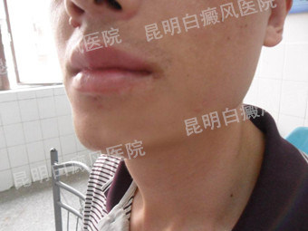 轻松挥别白癜风 还我俊俏脸庞