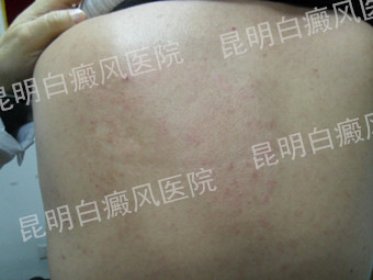 男性背部散发型白癜风6个月