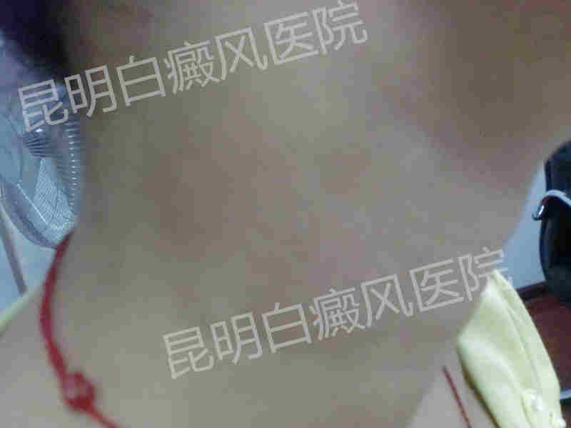 17岁女性颈部患白癜风2年