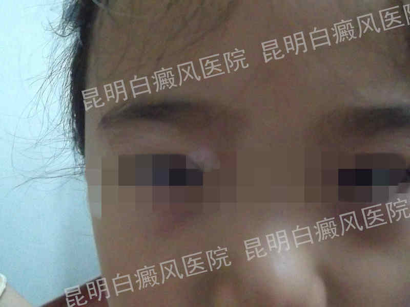 8岁女孩眼角白癜风半年