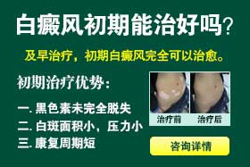 白癜风初期能治好吗?