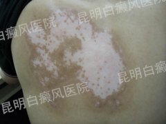 小医院能治疗白癜风吗?