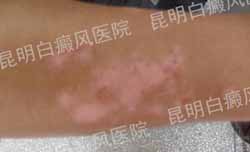 男性手臂块状大面积白斑5年