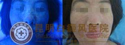 轻松告别白斑 还我丽人容颜
