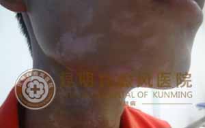 青春小伙无需为白斑担忧