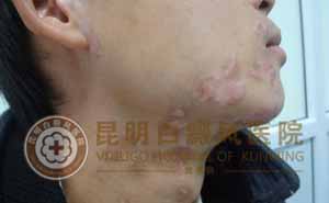 青春小伙无需为白斑担忧