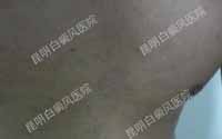 精细化治疗让白斑恢复更快速