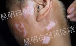 18岁女性面部患白癜风3年