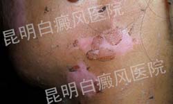 18岁女性面部患白癜风3年