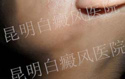 18岁女性面部患白癜风3年