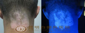 消除后颈5年大白斑,让大学不留遗憾
