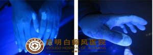 “二手”白斑患者再也不用为白癜风而苦恼了