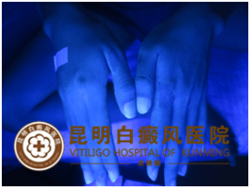 “二手”白斑患者再也不用为白癜风而苦恼了