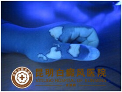 “二手”白斑患者再也不用为白癜风而苦恼了