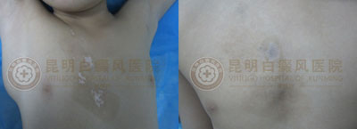 开学季,您孩子的白斑治好了吗?