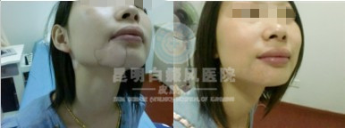 白癜风症状是什么?