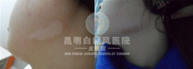 白癜风危害究竟有哪些呢?