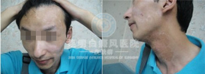 白癜风患者不能吃什么食物