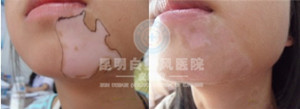 儿童白癜风怎样治疗?