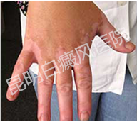 白癜风为何偏爱青少年?