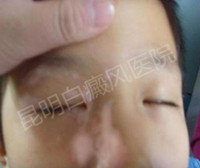 青少年白癜风病有何治疗优势?