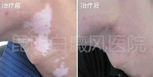 男性白斑怎么治?