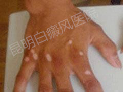 预防青少年白癜风的方法?