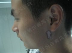 男性得了白癜风有哪些危害?