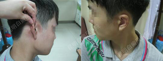 青少年面部白癜风4个月