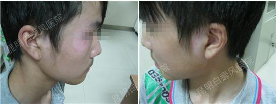 青少年面部白癜风4个月