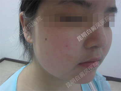15岁女性面部、颈部患白斑一年半