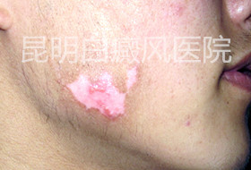 男性面部白癜风能治愈吗?