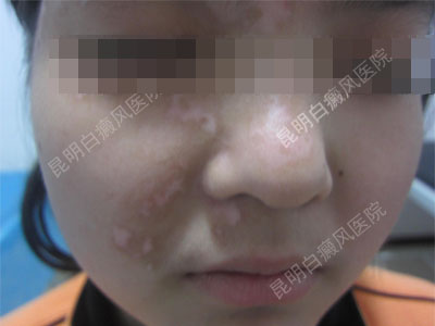 15岁女性面部、颈部患白斑一年半