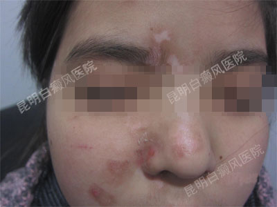 15岁女性面部、颈部患白斑一年半