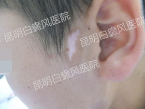 10岁男孩左耳旁白斑一年康复案例
