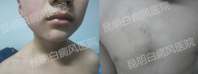 男胸部、颈部白斑一年半