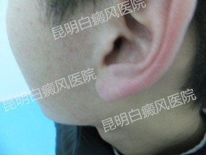 10岁男孩左耳旁白斑一年康复案例