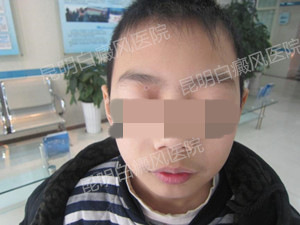 面部及腰部白斑1年