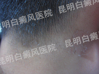 男性后颈部白癜风半年