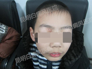 面部及腰部白斑1年