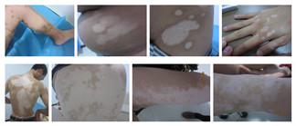 身上长白斑是白癜风吗?